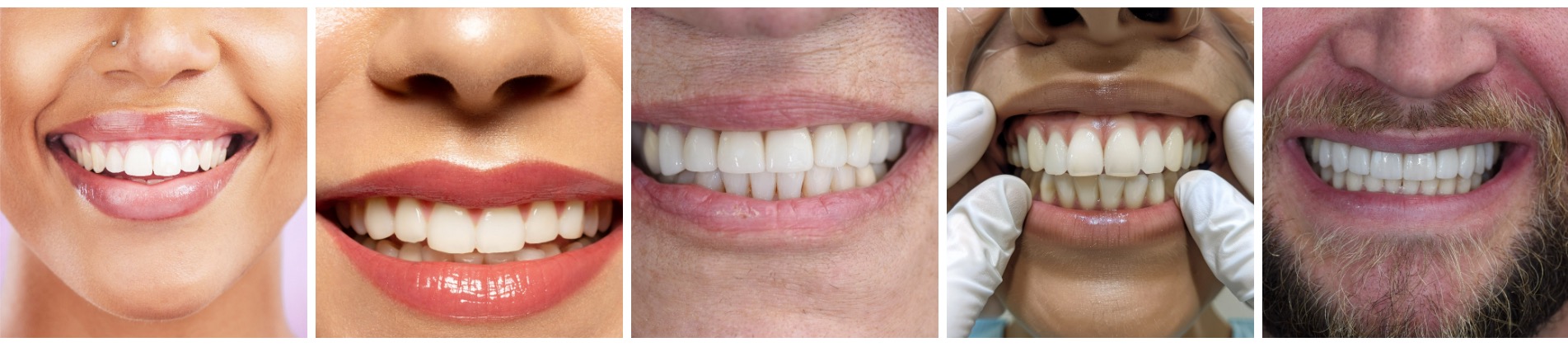 smilemakeover-smaple
